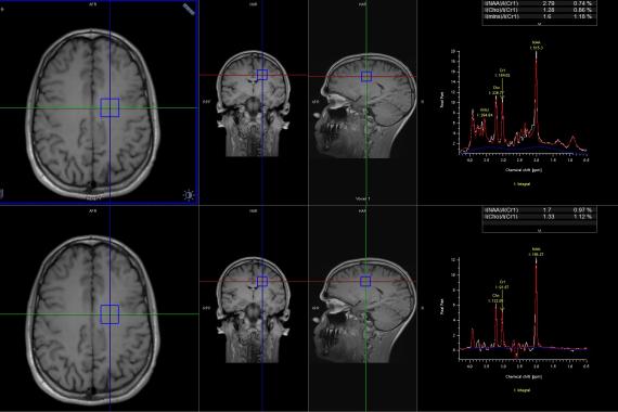 brain imaging